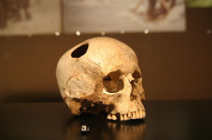 800px-Crane-trepanation-img_0507